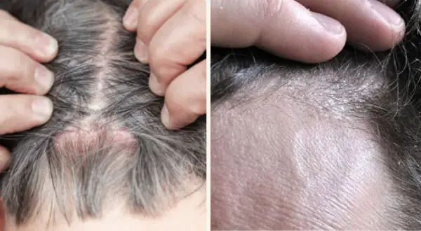 Primer plano de un cuero cabelludo con descamación, mostrando piel irritada y escamas blancas entre el cabello.