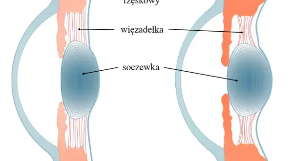Jak działa soczewka oka i dlaczego ma kluczowe znaczenie dla wzroku