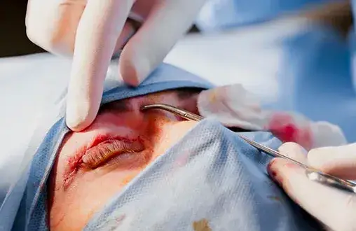 Blefaroplastyka górnych vs dolnych powiek – czym się różnią i kiedy je łączyć?
