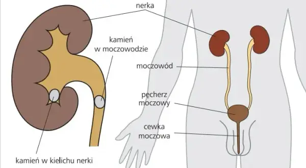 Czy alkohol przy kamicy nerkowej? Poznaj fakty i zagrożenia