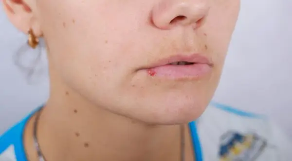 Czy z opryszczką można iść do dentysty? Ryzyka i zalecenia przed wizytą