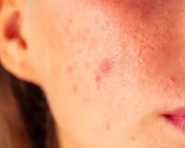 Pryszcz który nie znika: co oznacza i kiedy iść do dermatologa