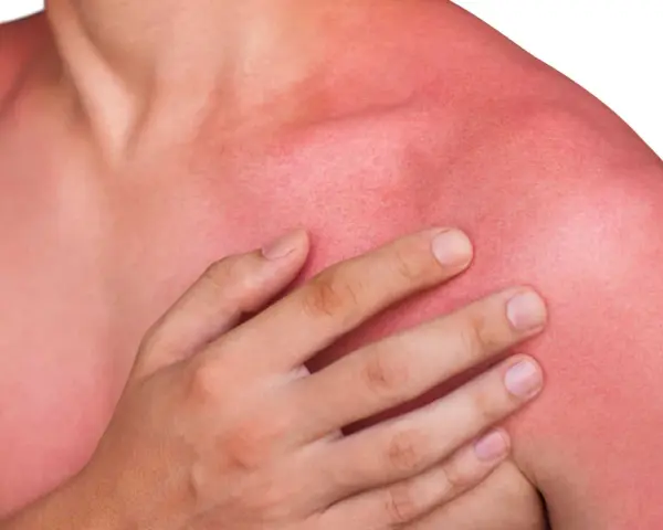 En person med kraftigt solbränd, röd hud på axlar och bröst. Känns som att vara allergisk mot solen.