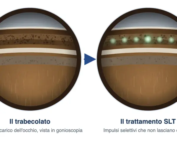 Trabeculoplastica laser selettiva: prima e dopo il trattamento SLT. Impulsi laser che migliorano il drenaggio oculare, minimizzando i rischi di cicatrici.