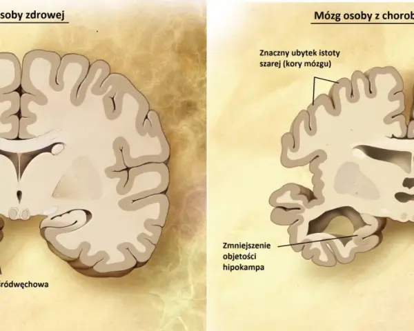 Porównanie mózgu zdrowego z mózgiem osoby z chorobą Alzheimera, ukazujące zanik kory mózgowej i hipokampa, typowe dla chorób neurodegeneracyjnych.