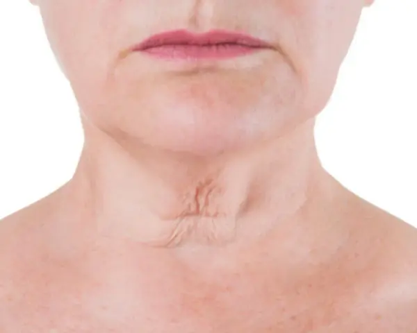 Primer plano del cuello de una mujer, mostrando arrugas en el cuello y la piel con pecas.