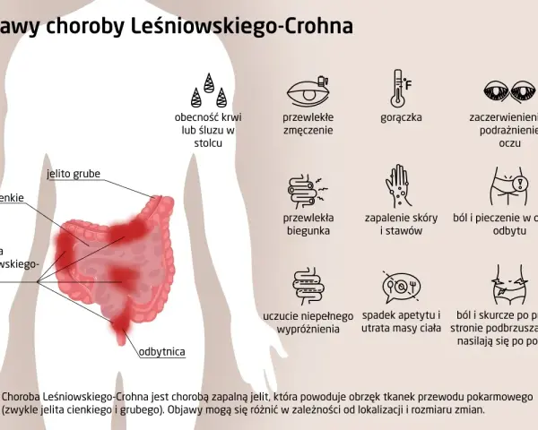 Objawy choroby Leśniowskiego-Crohna: krew w stolcu, zmęczenie, gorączka, problemy z oczami, biegunka, bóle brzucha, zapalenie skóry i stawów.