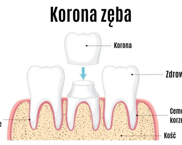 Ilustracja pokazuje proces zakładania korony zęba. Widoczne są zdrowe zęby, cement korzeniowy, kość i więzadło przyzębne.