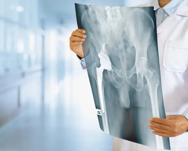 Lekarz analizuje RTG miednicy z widocznym endoprotezą stawu biodrowego, co może być związane z chorobą zwyrodnieniową lub chrzęstniak kości.