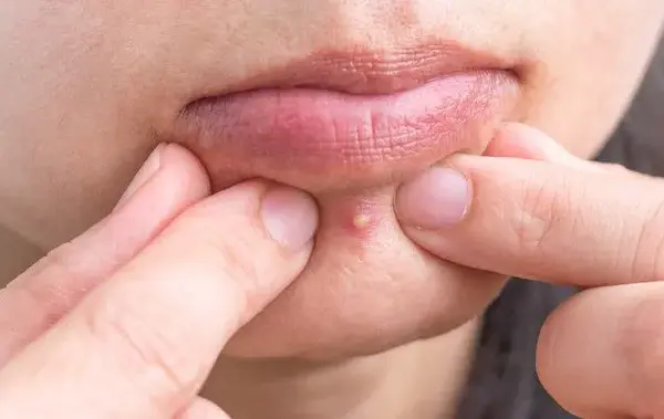 Jak pozbyć się podskórnego pryszcza? Szybkie i bezpieczne domowe sposoby