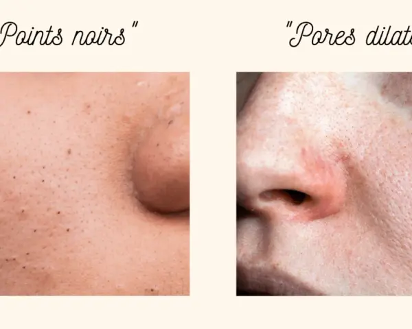 Gros plan sur la peau : points noirs d'un côté, et de l'autre, une zone avec des pores dilatés, suggérant un traitement.