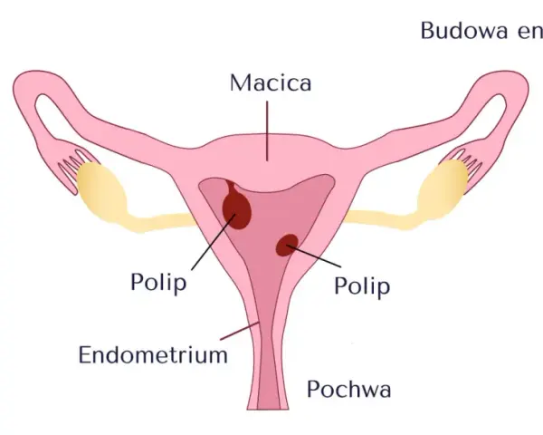Ilustracja przedstawia budowę macicy z widocznymi polipami w endometrium.