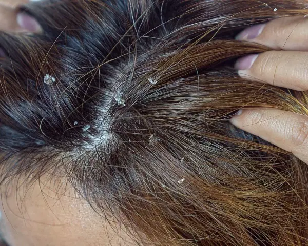 Widoczne białe płatki na ciemnych włosach. Czy to łupież? Dowiedz się, dandruff co to jest i jak sobie z nim radzić.