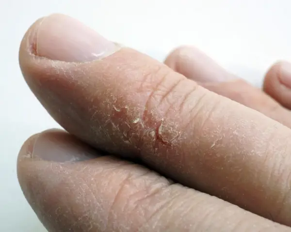 Gros plan sur des doigts aux bouts secs, la peau craquelée et desquamée.