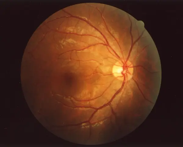 Il fundus oculi cos'è? Un'immagine della retina con vasi sanguigni rossi e aree biancastre, rivelando la sua complessa struttura interna.