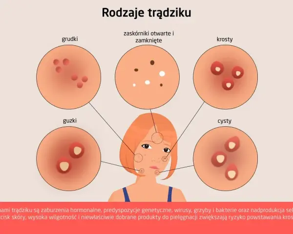 Ilustracja przedstawia różne rodzaje trądziku: grudki, zaskórniki, krosty, guzki i cysty.
