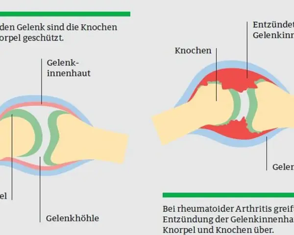 Die häufigsten Symptome der rheumatoiden Arthritis und ihre Folgen