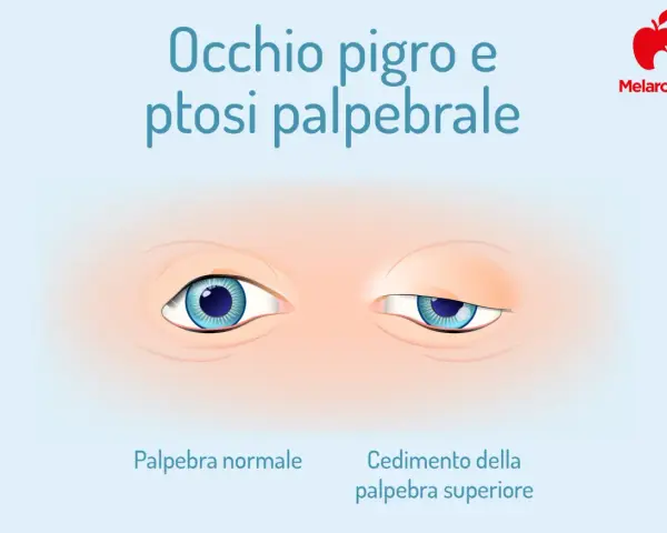 Occhio pigro e ptosi: confronto tra palpebra normale e cedimento. Ambliope cosa significa?