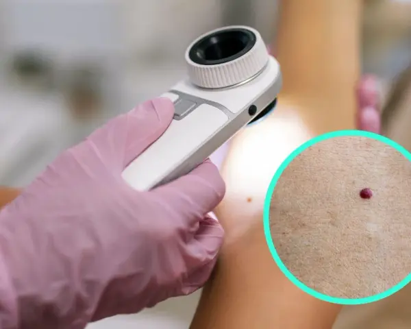 Dermatolog bada punkty rubinowe na skórze. Czerwone kropki na ciele mogą być powodem do niepokoju, ale często są niegroźne.