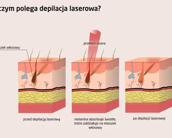 Ilustracja pokazuje, jak działa depilator laserowy: promień lasera trafia w mieszek włosowy, niszcząc go.