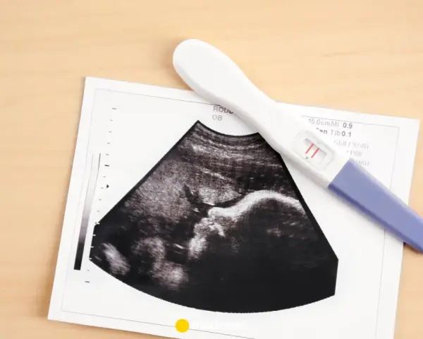 USG pokazuje pęcherzyk ciążowy, a obok leży pozytywny test ciążowy.