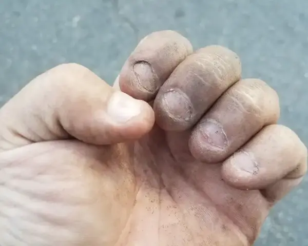 Brudne palce i zniszczone paznokcie, ślady po obgryzaniu paznokci.