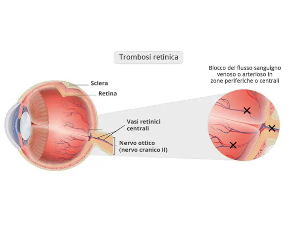 Diagramma occhio: trombosi retinica con blocco flusso sanguigno. Sintomi visivi possono manifestarsi in zone periferiche o centrali.