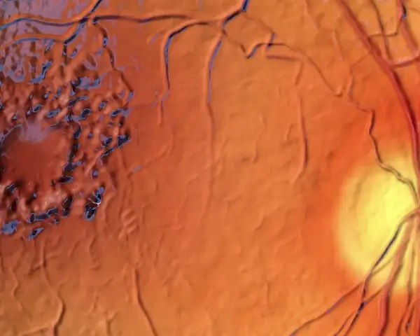 Edema maculare cistoide: la macula appare gonfia e irregolare, con aree scure che suggeriscono le cause. Vasi sanguigni retinici visibili.