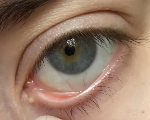 Ojo con milium en el contorno. Pequeños puntos blancos bajo la piel, un desafío para eliminar milium contorno ojos.