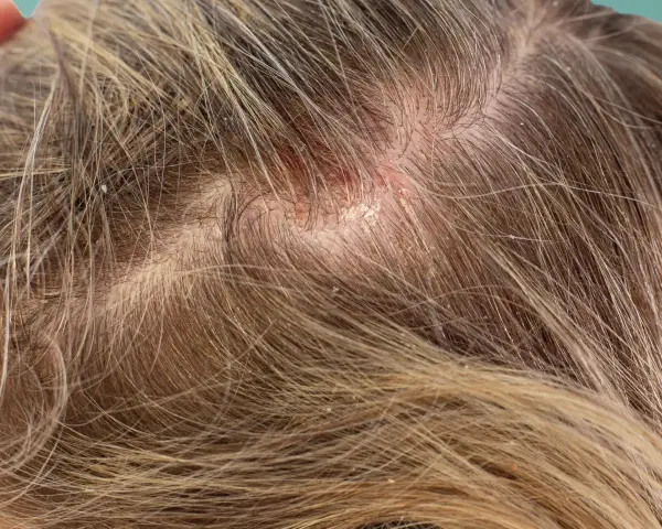 Nahaufnahme der Kopfhaut mit deutlichen Anzeichen von schuppen oder trockene kopfhaut, die sich zwischen den Haaren abzeichnen.