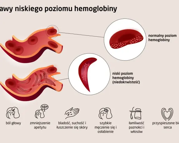 Ilustracja porównująca krwinki czerwone przy normalnym i niskim poziomie hemoglobiny, z ikonami objawów.