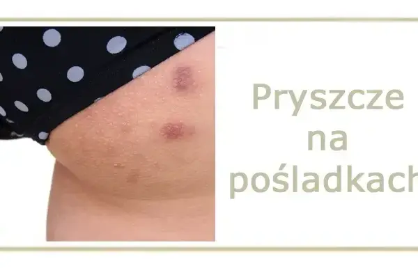Jak szybko wysuszyć pryszcza? Skuteczne metody i czego unikać