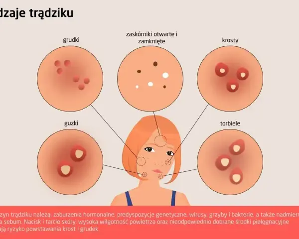 Ilustracja przedstawia różne rodzaje krost na twarzy: grudki, guzki, zaskórniki, krosty i torbiele.