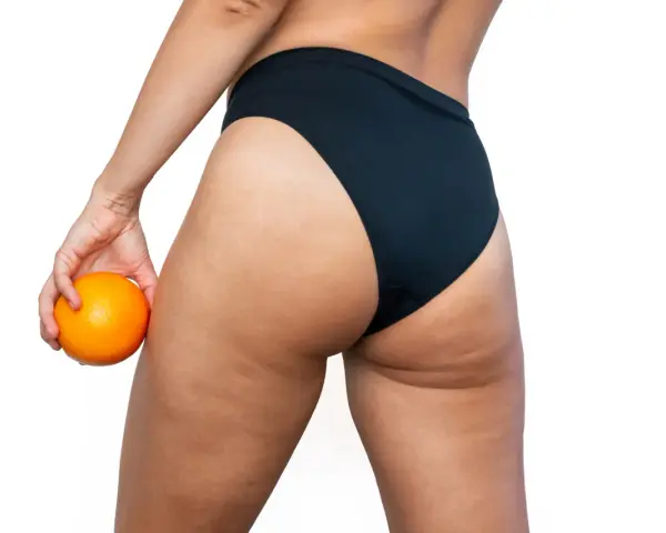 Mujer con naranja en mano, mostrando sus piernas y glúteos con celulitis. ¿Buscas como quitar celulitis piernas?