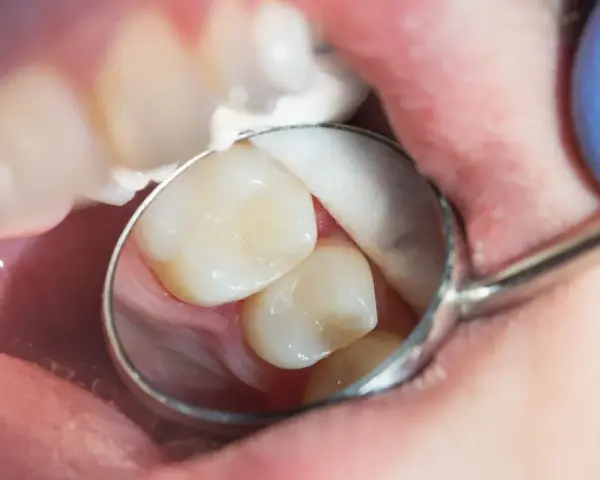 Zbliżenie na zęby w jamie ustnej, oglądane przez lusterko dentystyczne.