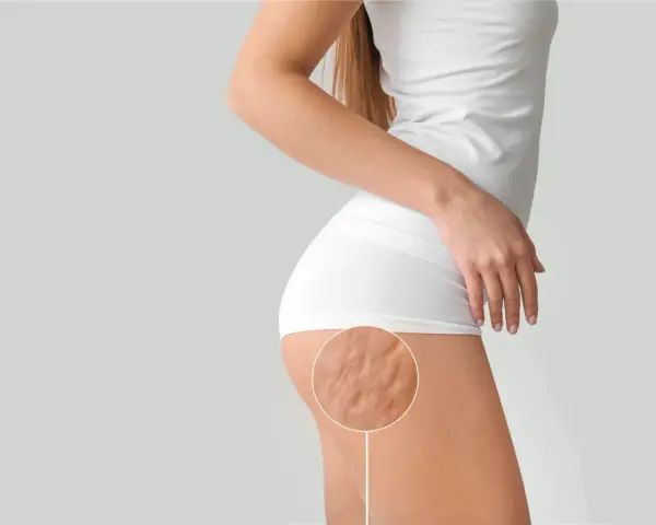 Nahaufnahme der Cellulite am Oberschenkel einer Frau. Hier wird gezeigt, was hilft gegen Cellulite.