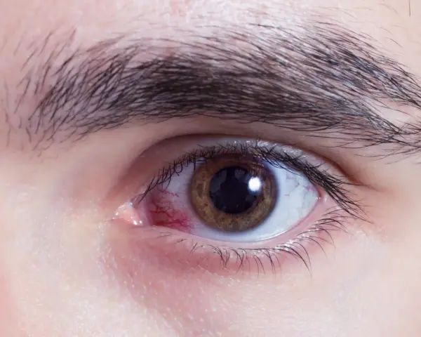 Occhio con sclera arrossata e iride marrone, suggerisce un'abrasione corneale dovuta a occhio secco.