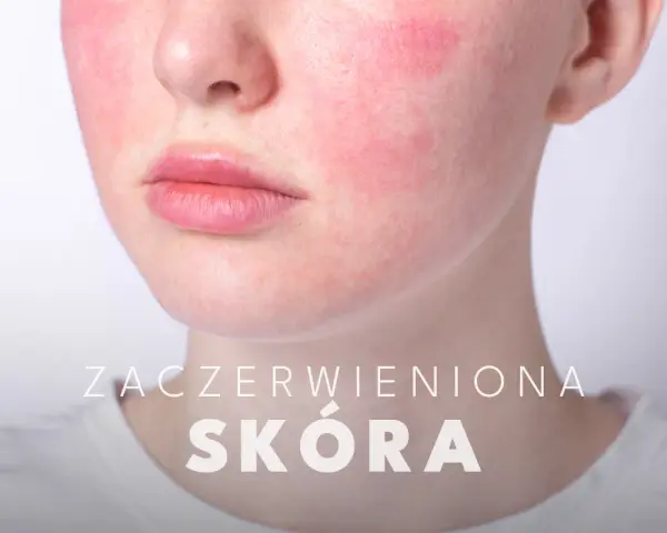 Uczucie gorąca i czerwona twarz, widoczne zaczerwienienie na policzkach.