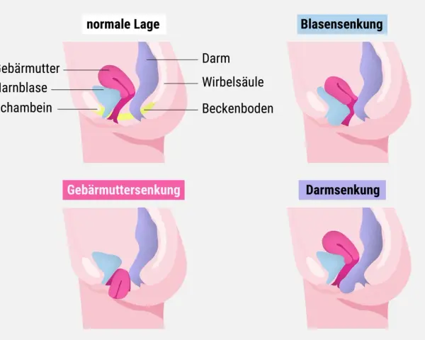 Schematische Darstellung des Beckenbodens: Normale Lage, Blasensenkung, Gebärmuttersenkung und Darmsenksung nach der Geburt.