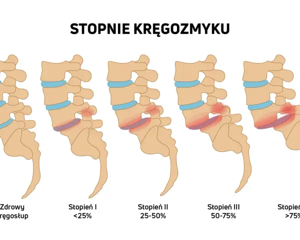 Ilustracja pokazuje stopnie kręgozmyku od zdrowego kręgosłupa do zaawansowanych stadiów, gdzie kręgi przesuwają się względem siebie.