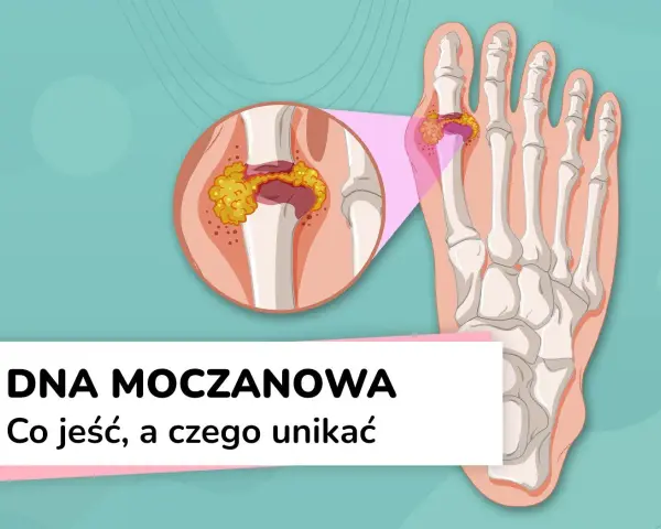 Dna moczanowa: powiększony staw palucha z kryształkami kwasu moczowego. Objawy dny moczanowej mogą być bolesne.