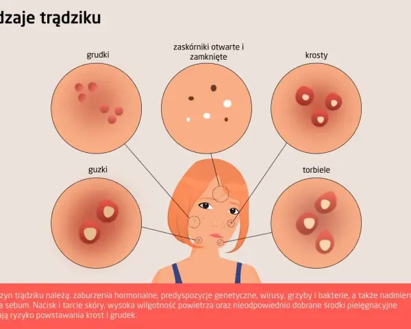 Ilustracja przedstawia różne rodzaje trądziku na skórze: grudki, zaskórniki, krosty, guzki i torbiele.