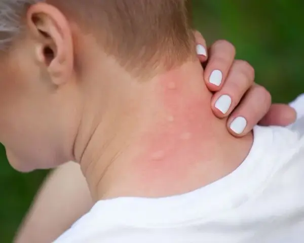 Jak wygląda alergia skórna zdjęcia - poznaj objawy i ich wygląd