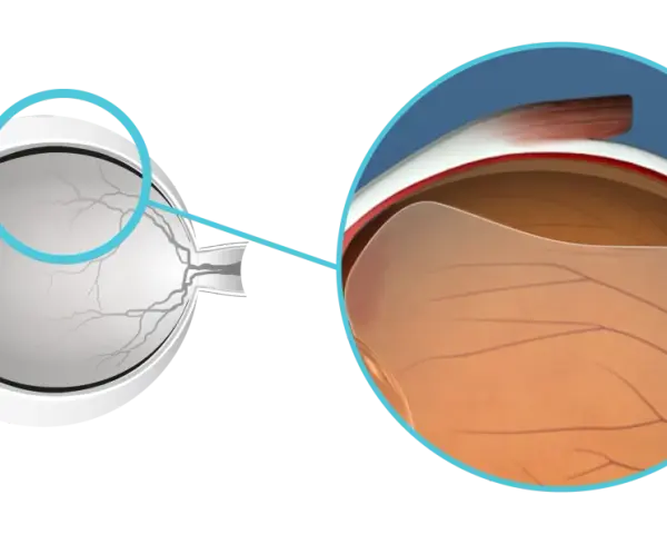Illustrazione anatomica dell'occhio che mostra il distacco posteriore di vitreo, cosa significa questa condizione.