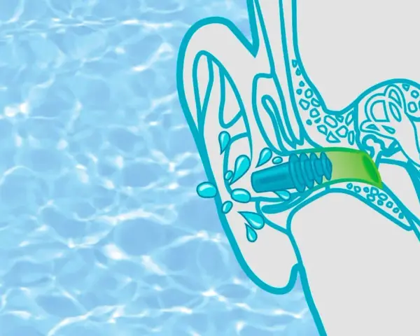Illustration zeigt ein Kind, das Wasser im Ohr hat. Ein Stöpsel schützt das Ohr vor weiterer Flüssigkeit.