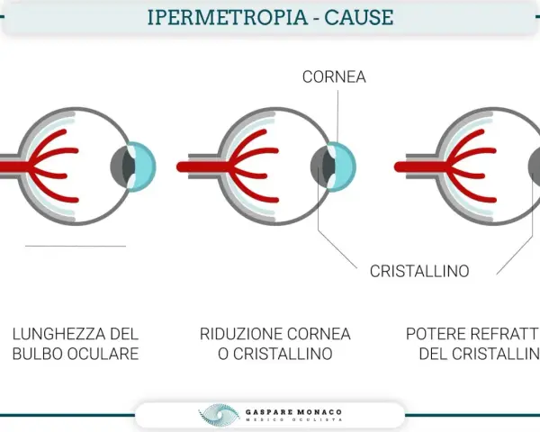 Illustrazione delle cause dell'ipermetropia: bulbo oculare corto, cornea o cristallino ridotti, o potere refrattivo del cristallino.