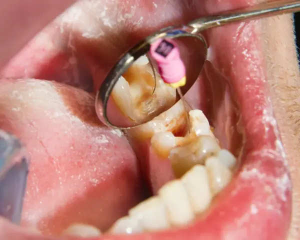 Dentysta podczas leczenia kanałowego zęba. W odbiciu lusterka widać narzędzie stomatologiczne i różowy kołeczek z oznaczeniem rozmiaru.