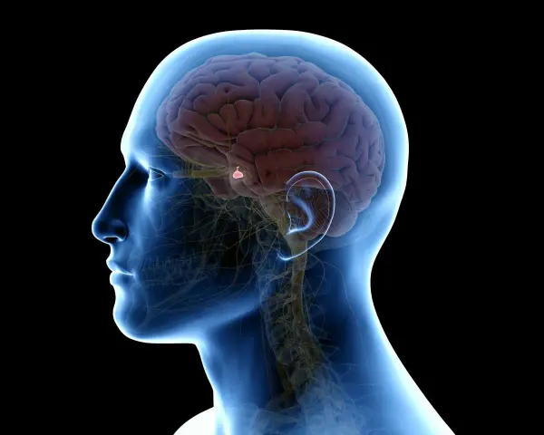 Anatomia mózgu z zaznaczonym guzem przysadki mózgowej. Choć rzadko, guz przysadki mózgowej może prowadzić do poważnych konsekwencji, a nawet śmiertelności.