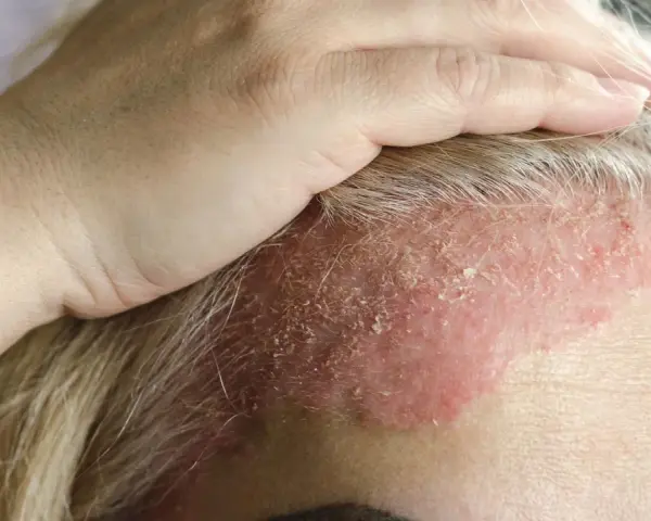 Dłoń dotyka czoła z zaczerwienioną skórą i łuszczącą się skorupą na głowie, wskazującą na problem dermatologiczny.