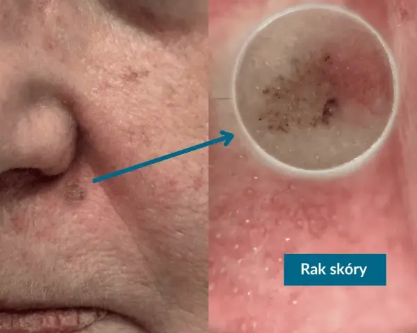 Niepokojący pieprzyk na nosie, powiększony dermatoskopem, ujawnia zmiany sugerujące raka skóry.